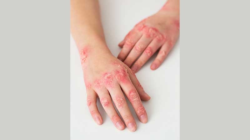 অ্যাটোপিক ডার্মাটাইটিস কাদের বেশি হয়