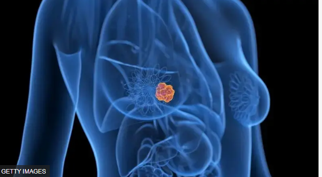 ভারতের অল্পবয়সী নারীদের মধ্যে স্তন ক্যান্সারের হার বৃদ্ধি পাচ্ছে