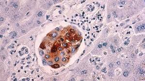 মহামারিতে স্বাস্থ্যসেবায় বিঘ্নে ক্যানসার রোগীর মৃত্যুহার বেড়েছে: গবেষণা