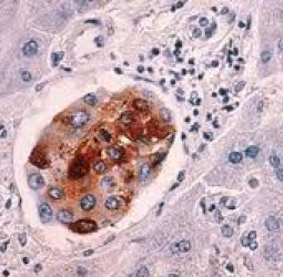 মহামারিতে স্বাস্থ্যসেবায় বিঘ্নে ক্যানসার রোগীর মৃত্যুহার বেড়েছে: গবেষণা